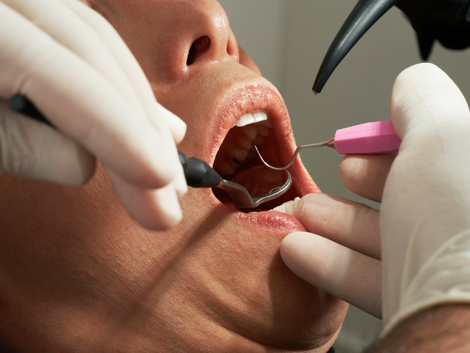 How to Treat Nerve Pain After Tooth Extraction: A Comprehensive Guide to Relief and Recovery